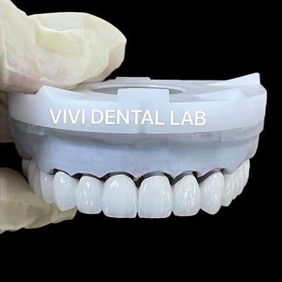 Superweiße Zirkonia-Kronen aus Dentallabor 3D PRO PFZ Noritake Porzellan