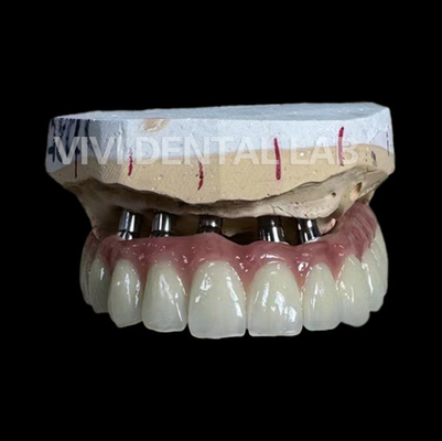 Zahnmedizinisches Labor Gesamtbrücken-Chinas des implantats-PFM