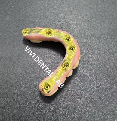 Voll Zirkonie-Brücke mit Titanstahlunterstützung China Dental Lab