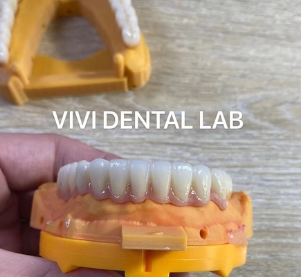 Vollkiefer Zahn Zirkonie Brücken Implantat Krone Durchsichtigkeit Ästhetisch