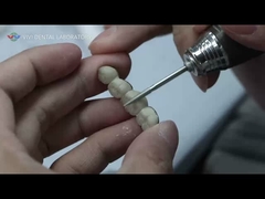 Metall-keramische Brücke