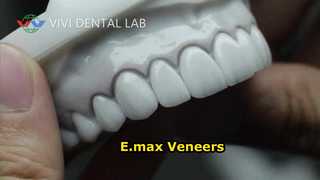 Dentalveneers-Laminate