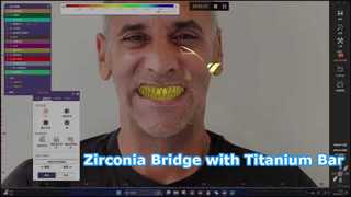 Zirconia Bridge Titanium Steg All-on-X-Lösung